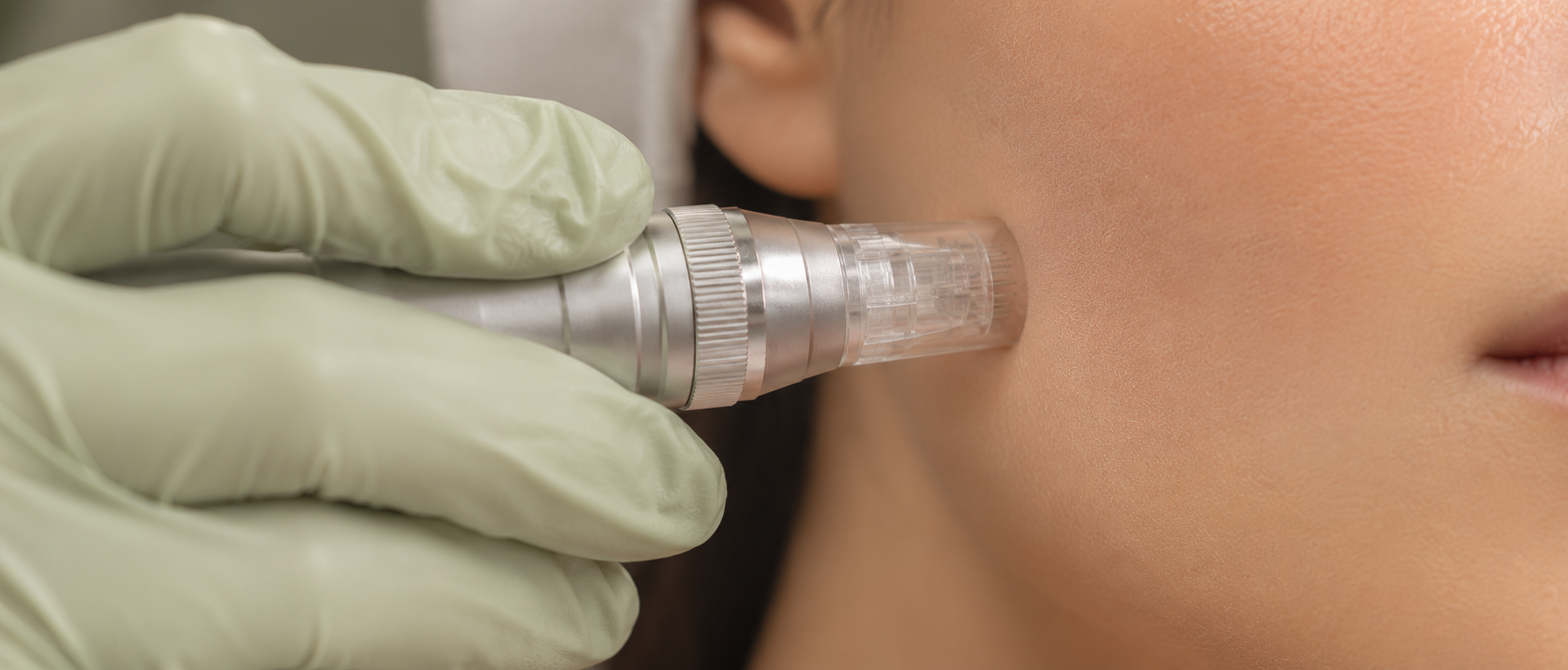 Microneedling pen on cheek