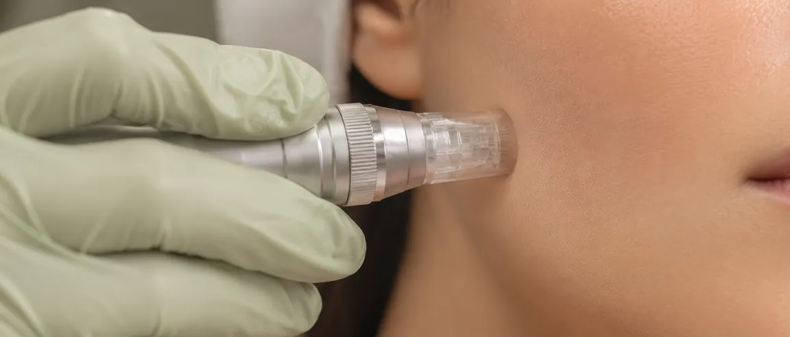 Microneedling pen on cheek